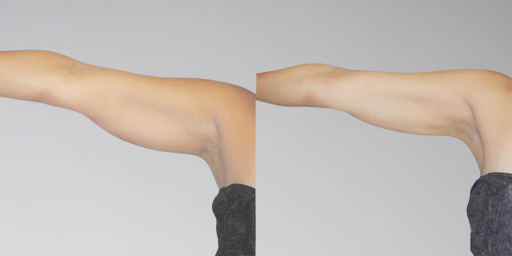 Arm Fat Removal Before and After Results