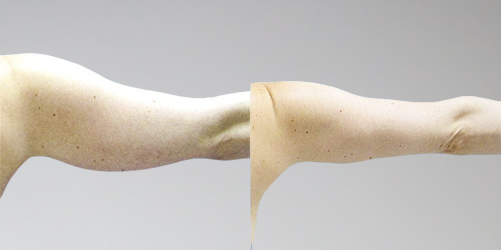 Before and After Arm Fat Removal