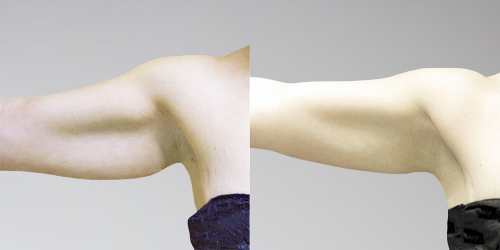 Before and after arm fat removal procedure