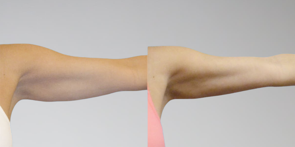 Before and After Results of Arm Liposuction