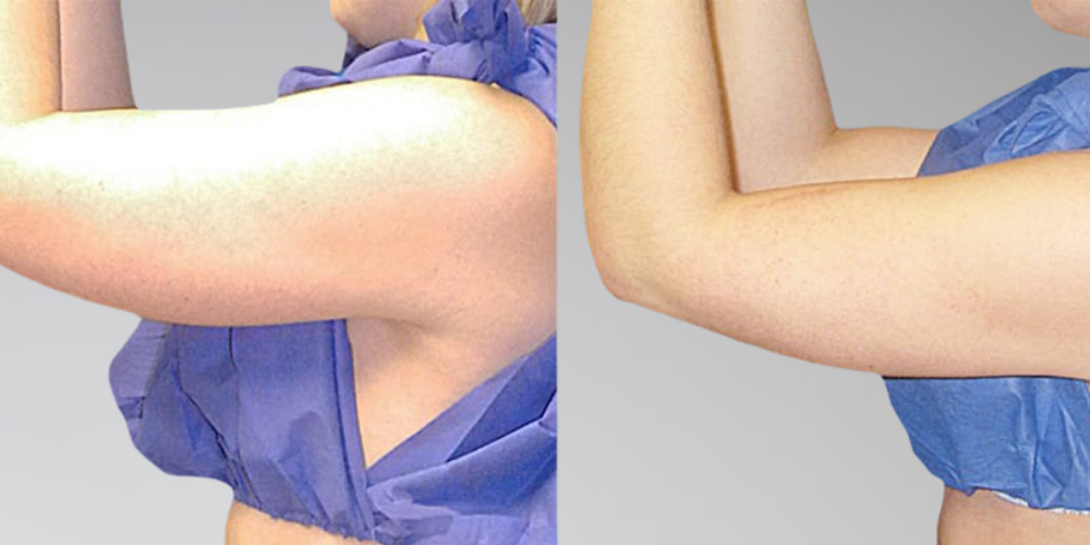 Arm Lipo Before and After Photo