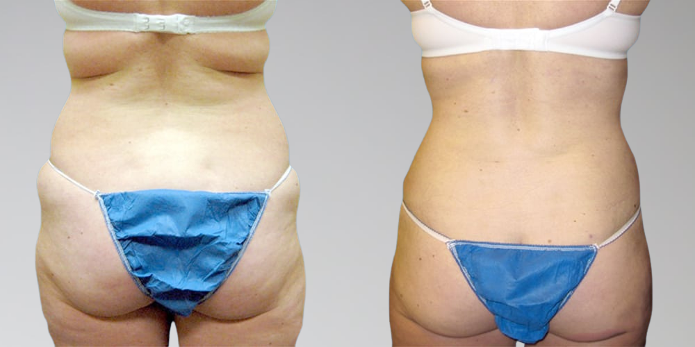 Back fat removal before and after results for women