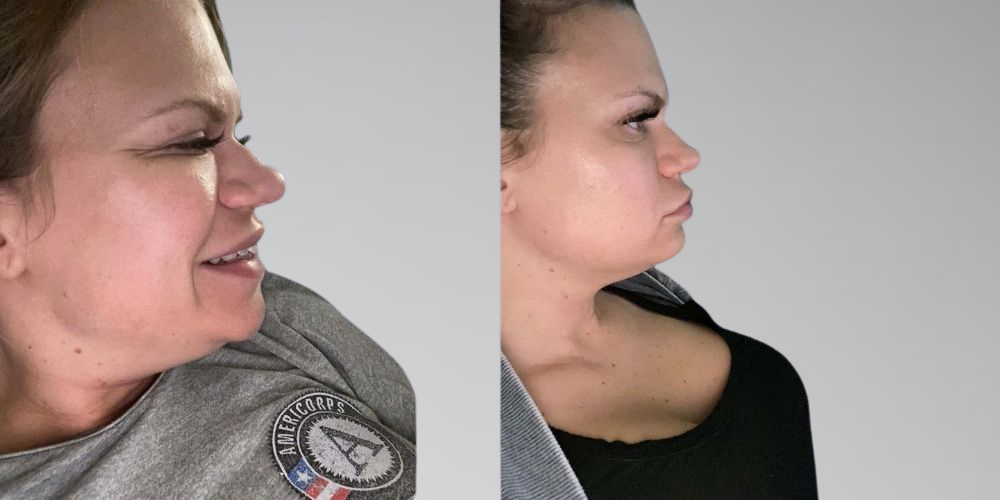 Chin fat removal before and after