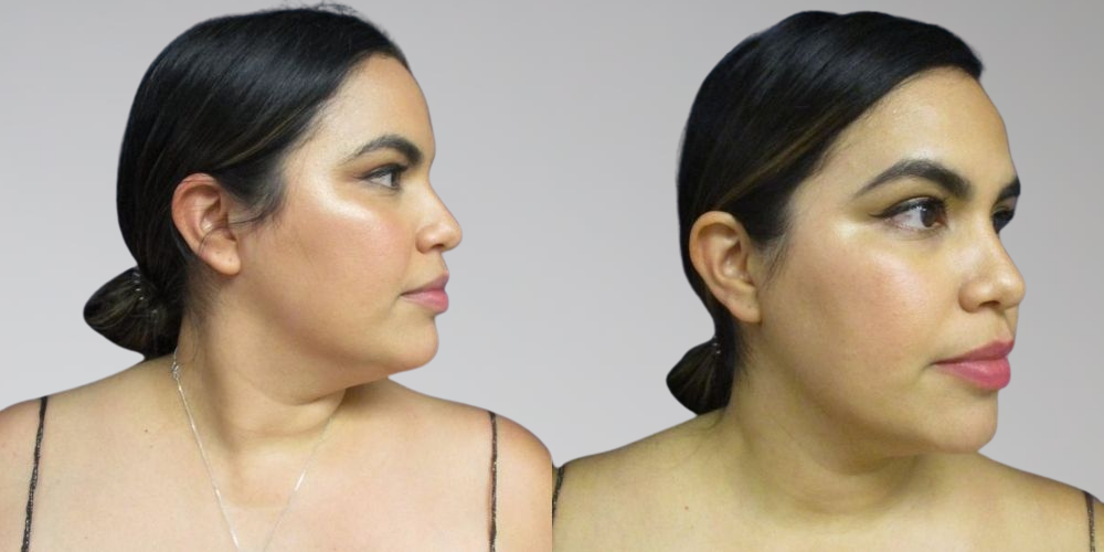 Before & After Chin Fat Removal Sono Bello Lipo Results