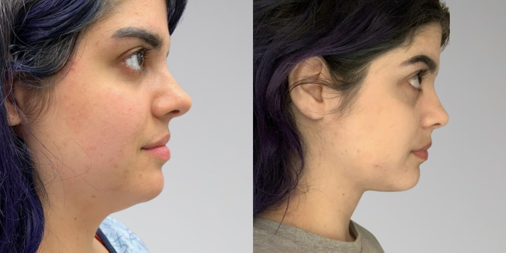 Before & After Chin Fat Removal Sono Bello Lipo Results