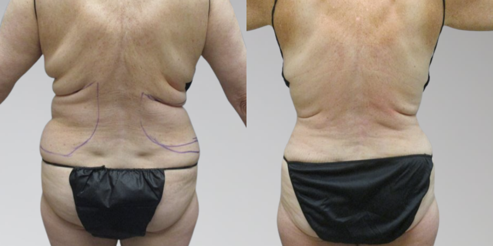 Female results for back liposuction