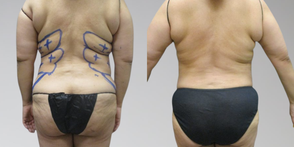 Back liposuction before and after at Sono Bello