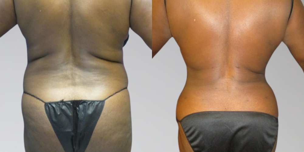 Women's before and after back lipo results