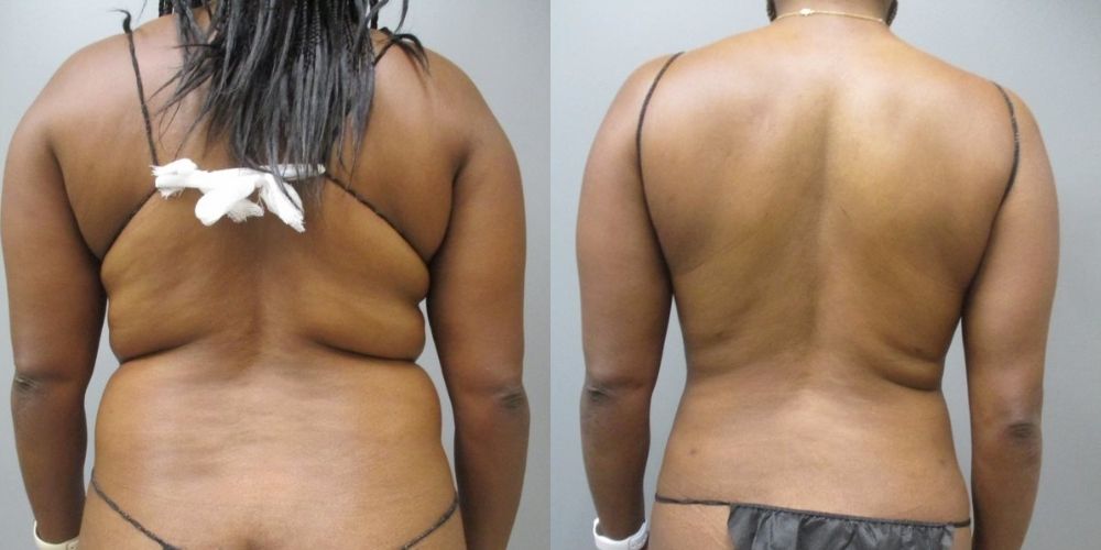 back fat removal before and after photo