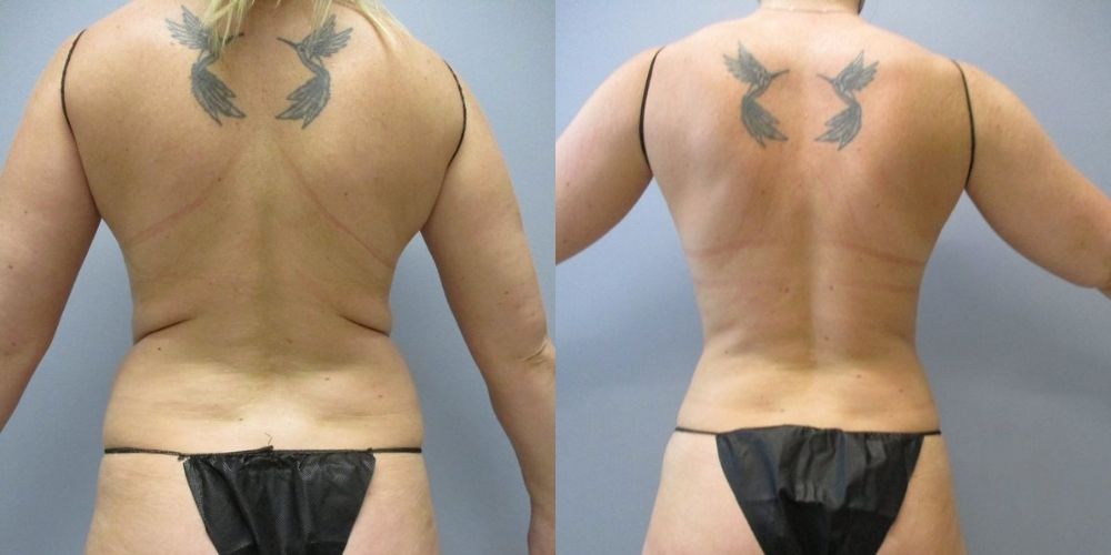 Before and After back liposuction results