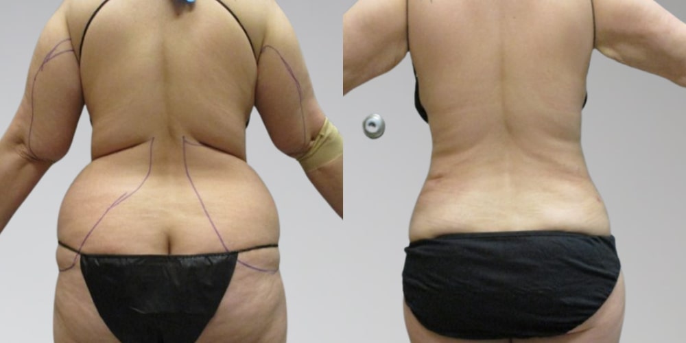 before and after Sono Bello back liposuction results