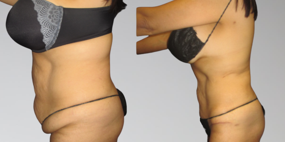 Stomach results before and after liposuction