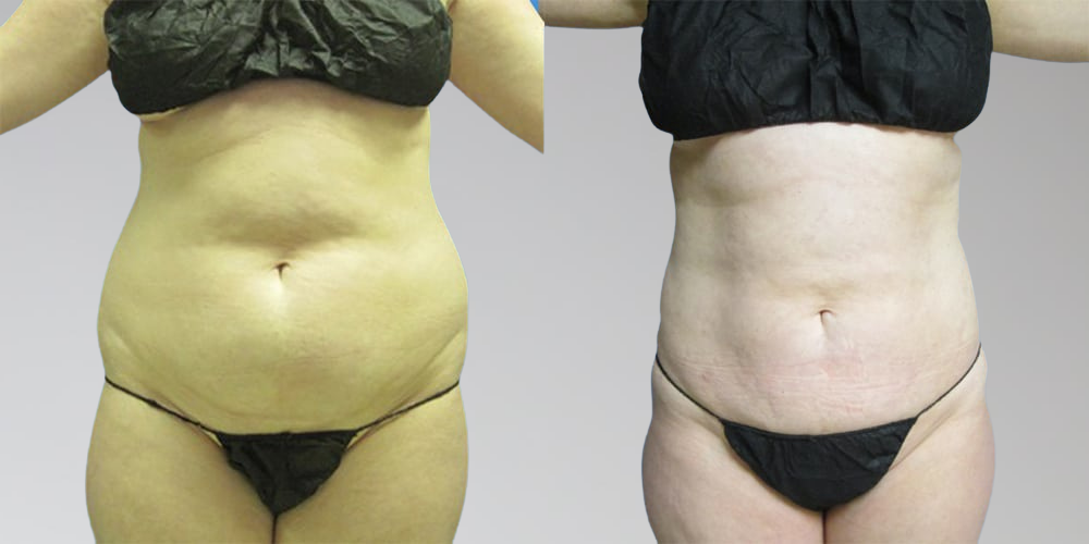 Before and after laser liposuction for stomach