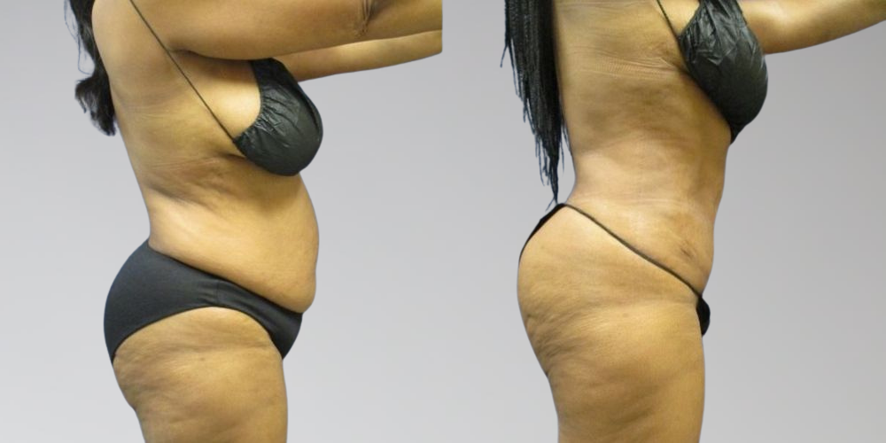 Stomach lipo before and after results