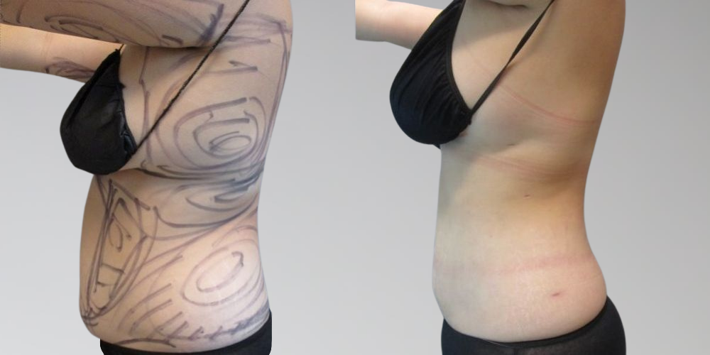Stomach lipo before and after
