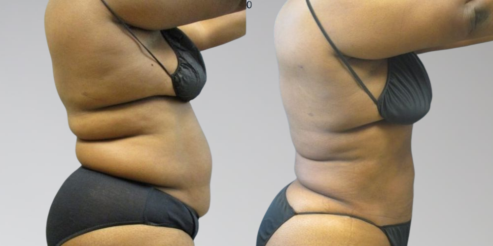 Laser liposuction before and after results