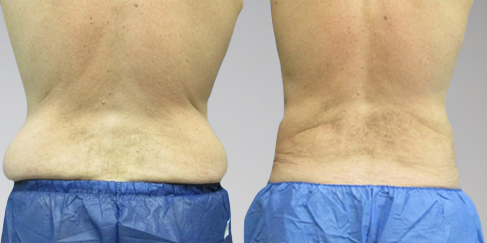 Back lipo before and after photos