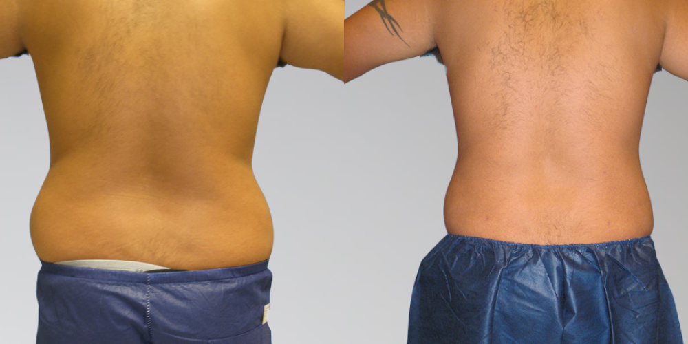 Male back liposuction results at Sono Bello