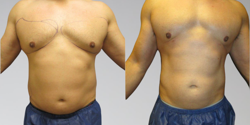 Male Liposuction Before & Afters Sono Bello Results