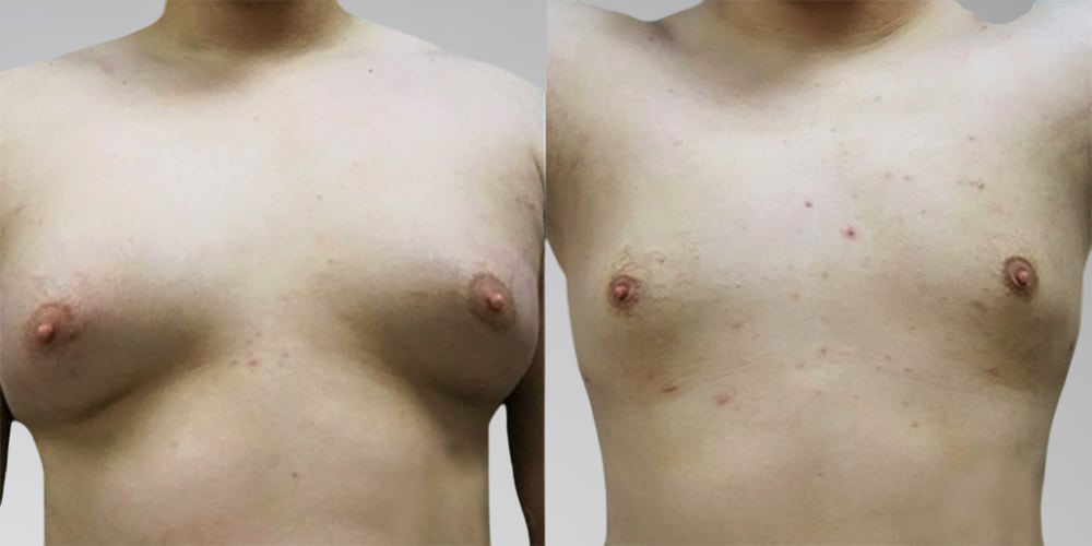 Male chest fat reduction before and after