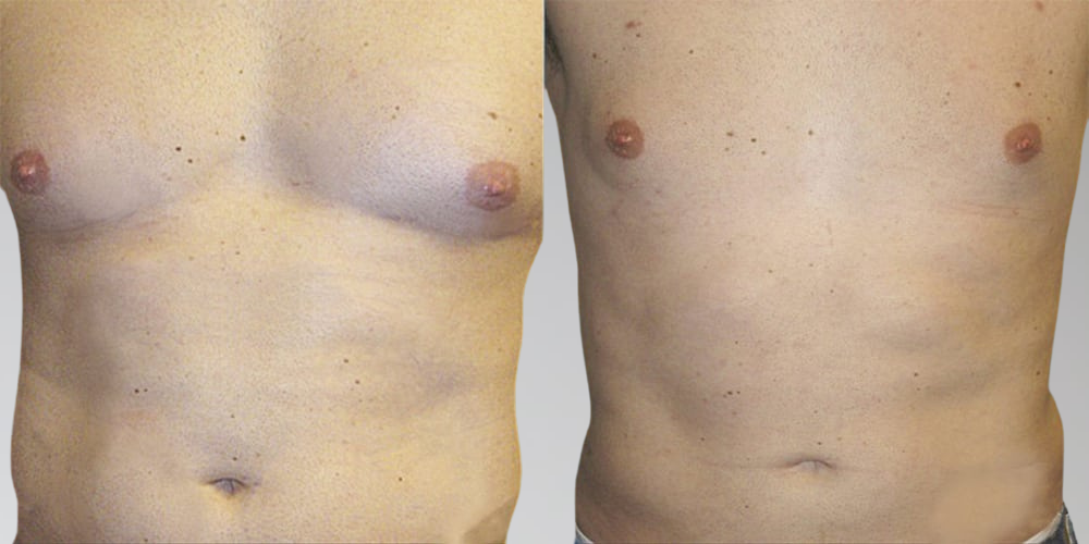 Results for male chest liposuction before and after