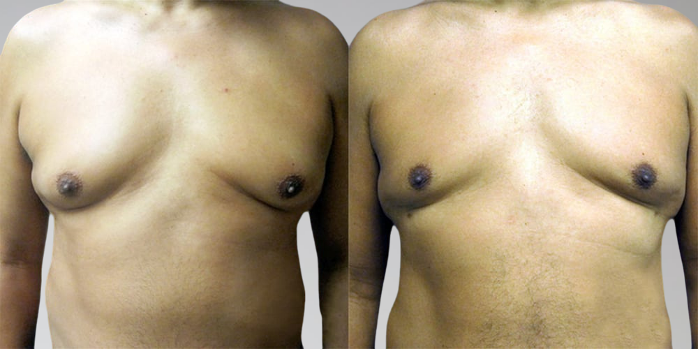 Male results for chest liposuction