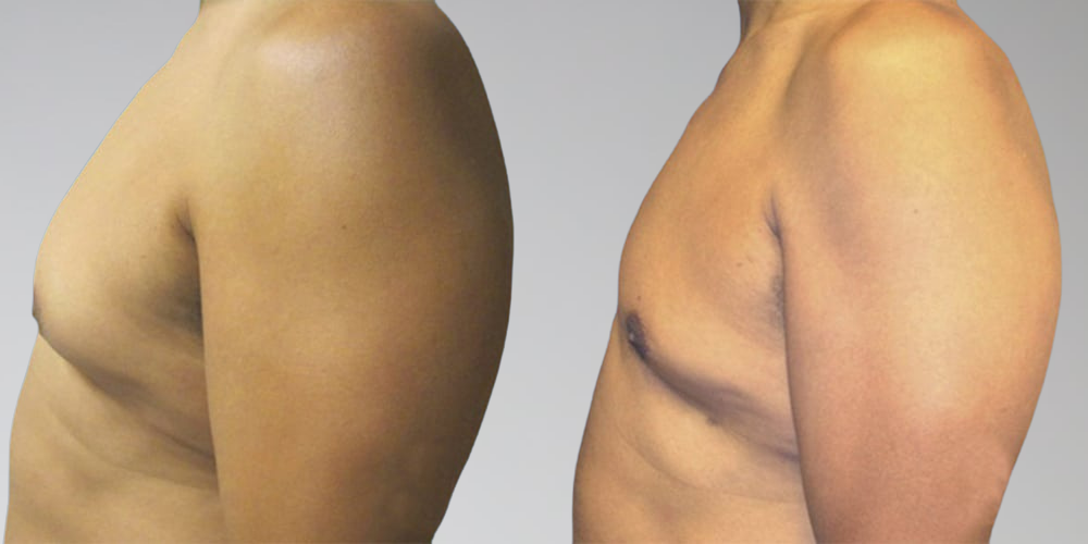 Before and after men's chest liposuction