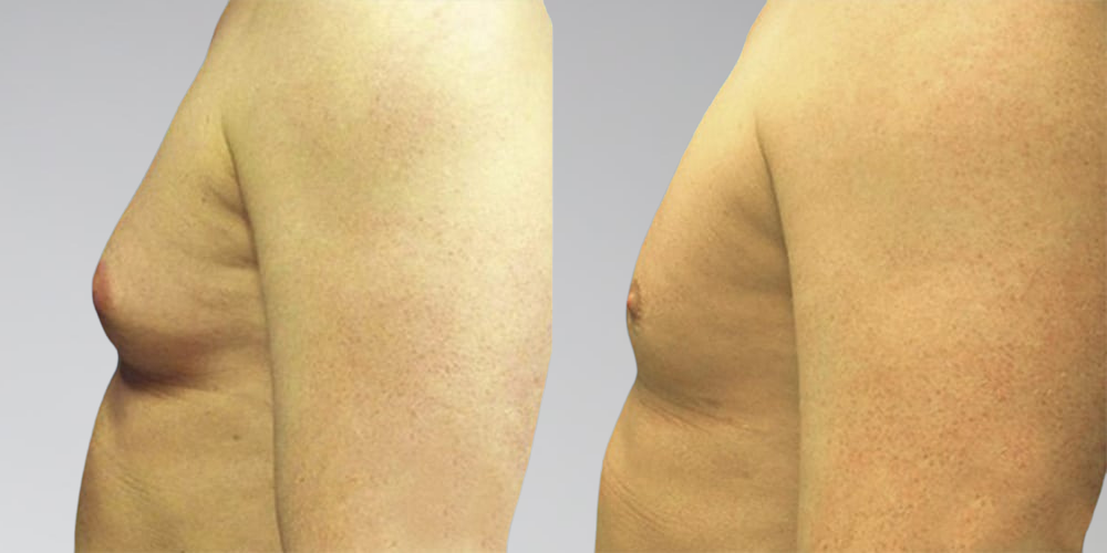 Male liposuction before and after for chest