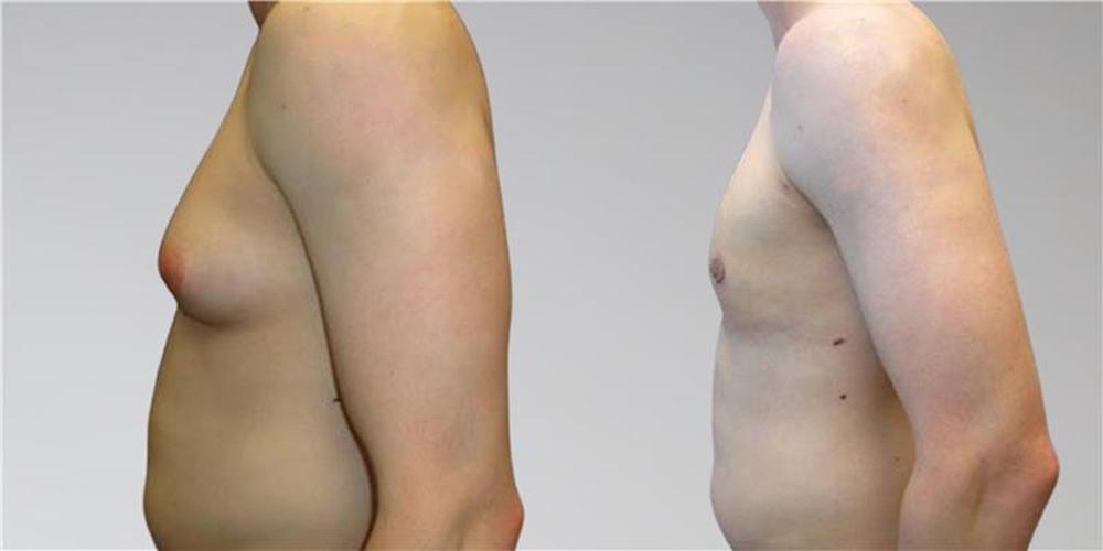 Male chest before and after laser liposuction