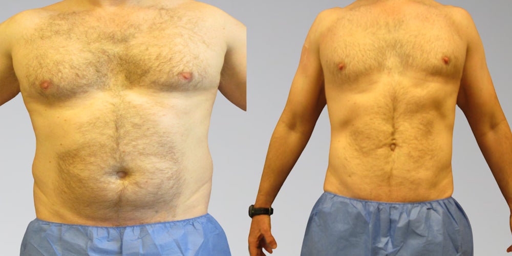 male stomach liposuction before and after