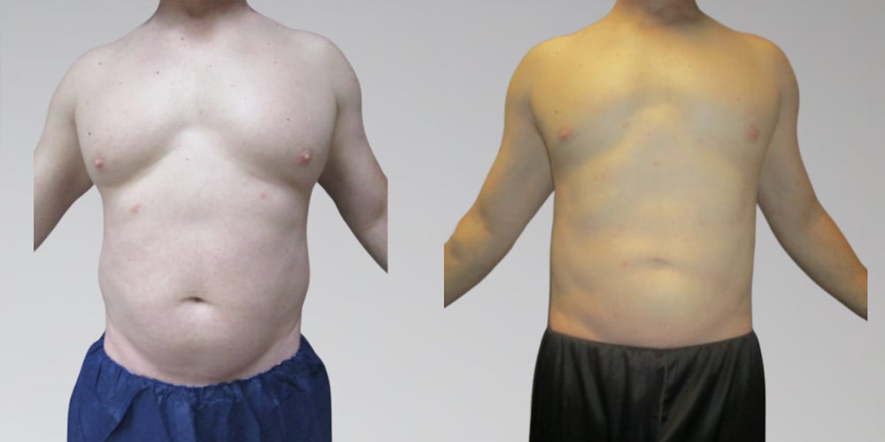 Liposuction before and after for male stomach