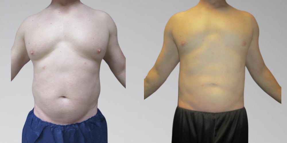 Men Before and After Stomach Liposuction Sono Bello