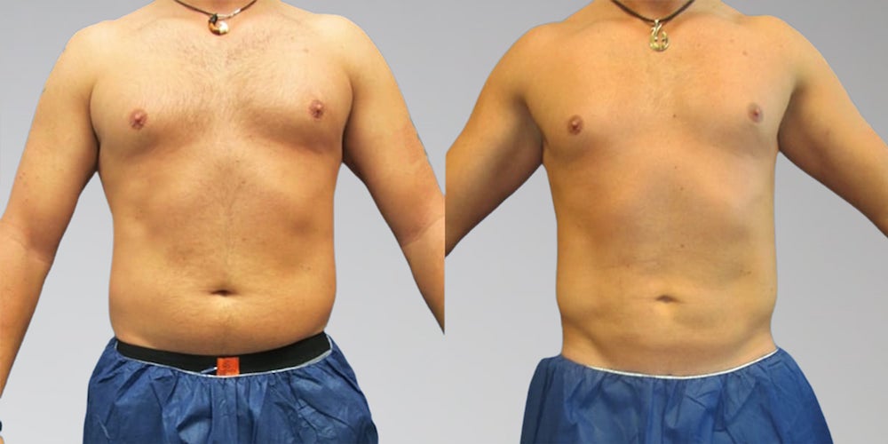 Male stomach before and after liposuction procedure