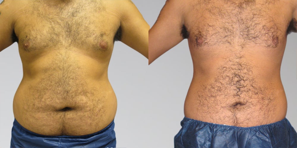 Lipo beofre and after for male stomach side-by-side