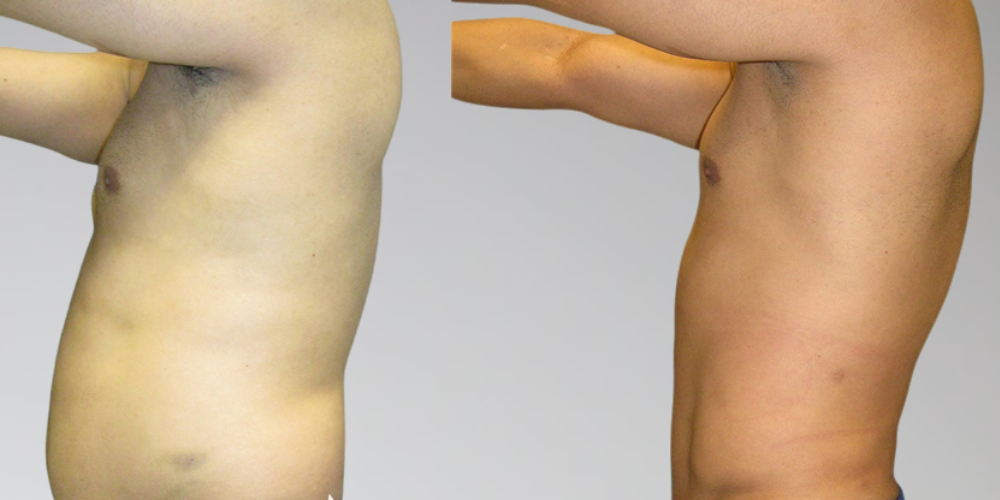 Side profile picture of stomach liposuction before and after results