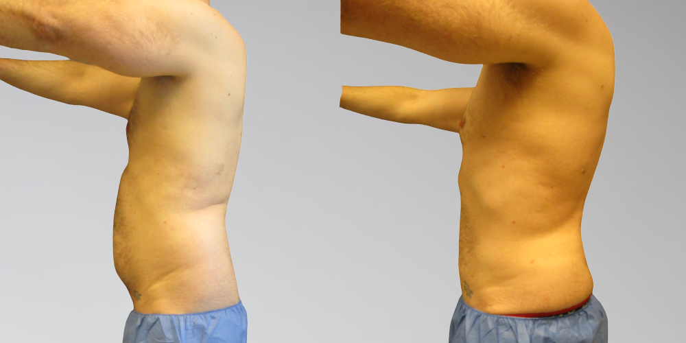 male stomach liposuction before and after side-view