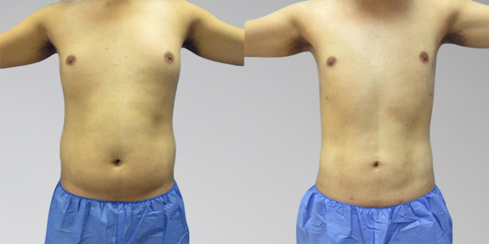Men Before and After Stomach Liposuction Sono Bello