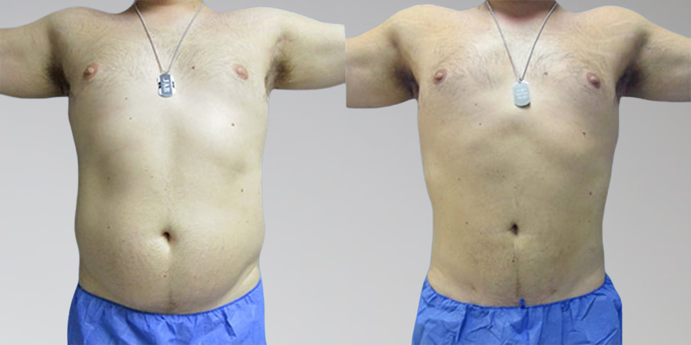 Stomach Liposuction Before & After for Males