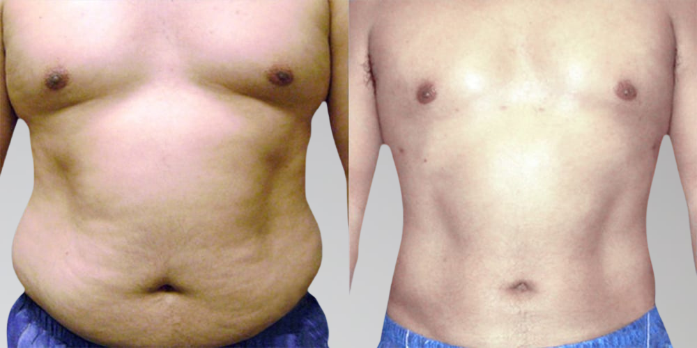 Male stomach before and after liposuction