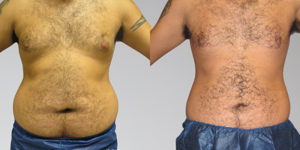Male side-by-side before and after liposuction