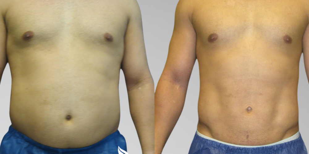 Men's side by side before and after liposuction results