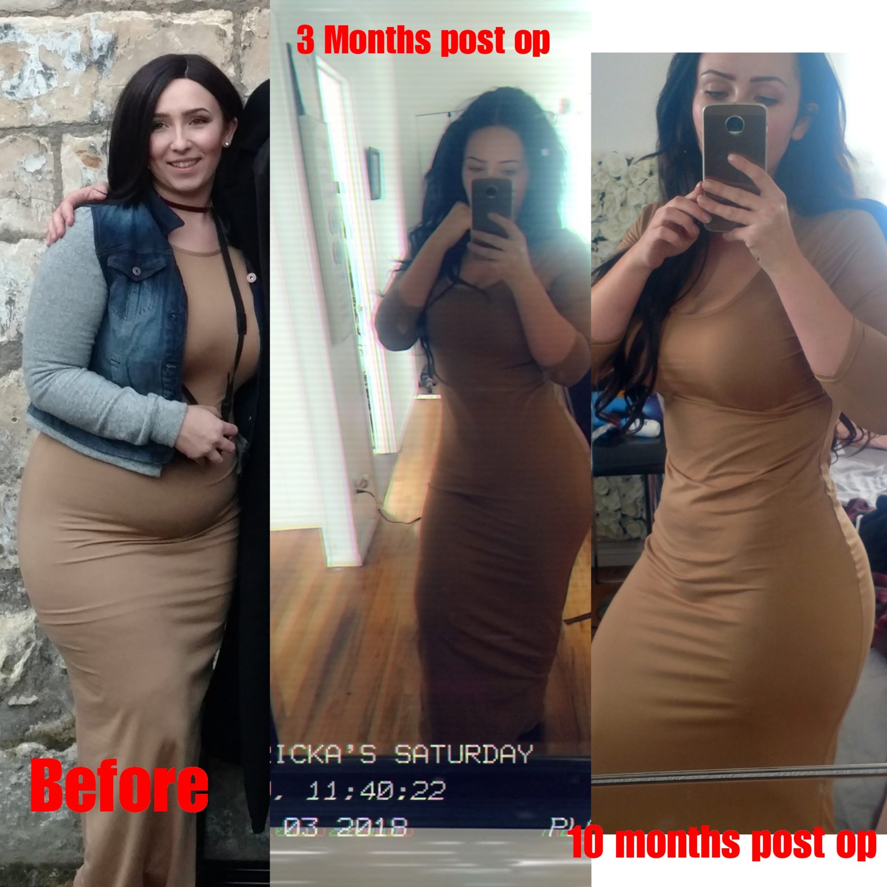 10 Months Post Sono Bello Procedure Sono Bello