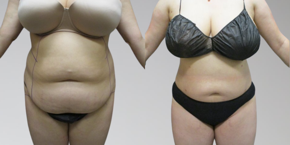 AbEX Lipo Before and After Results