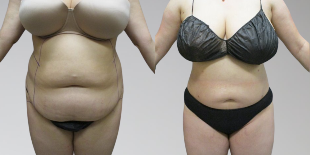 Liposuction and AbEX Before and After Results