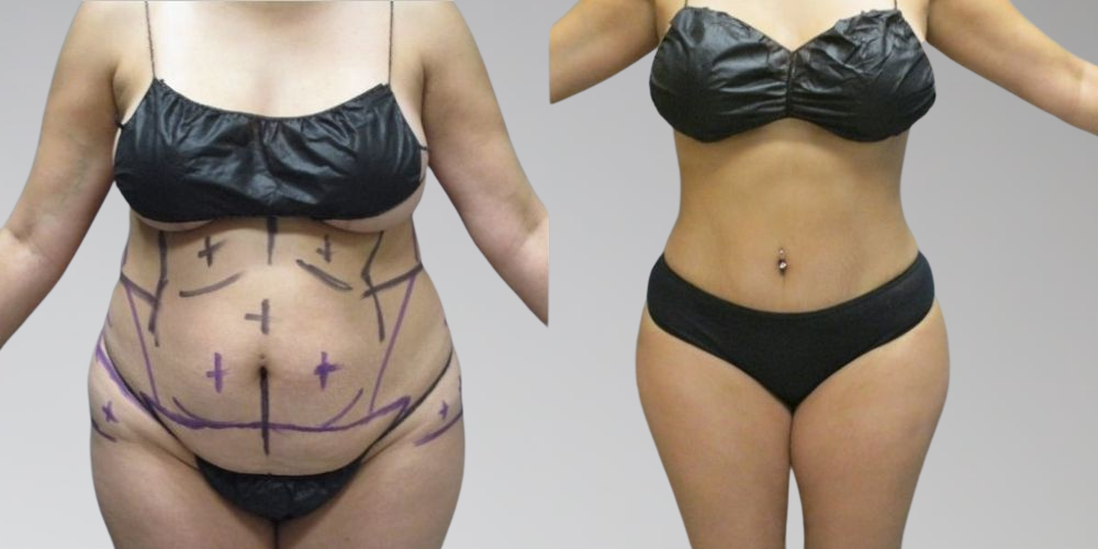 AbEX procedure before and after results for female patient