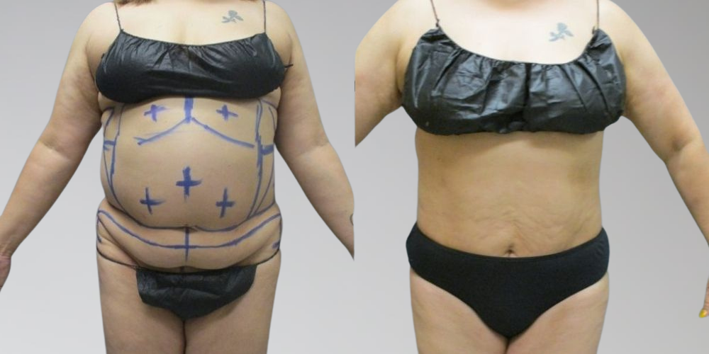 Female patient before and after laser liposuction and AbEX at Sono Bello