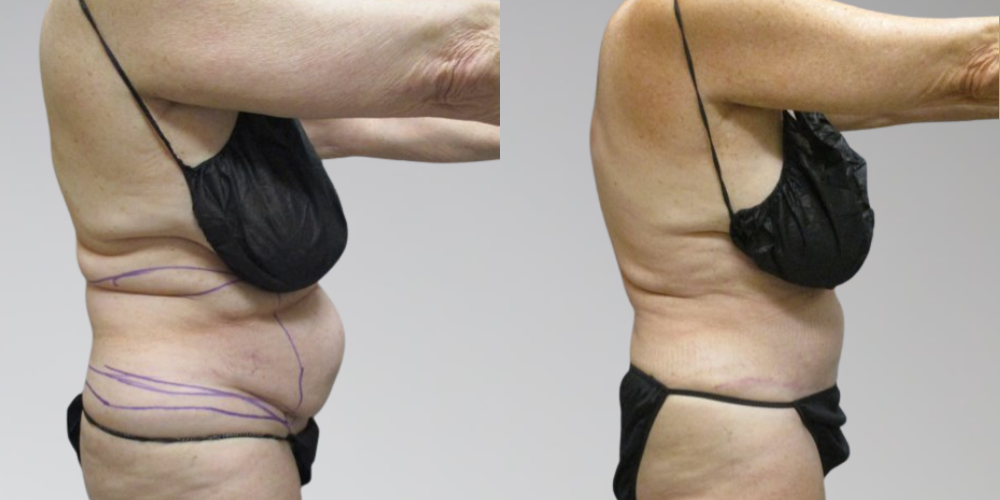 Before and after Sono Bello AbEX laser liposuction procedure side profile photo