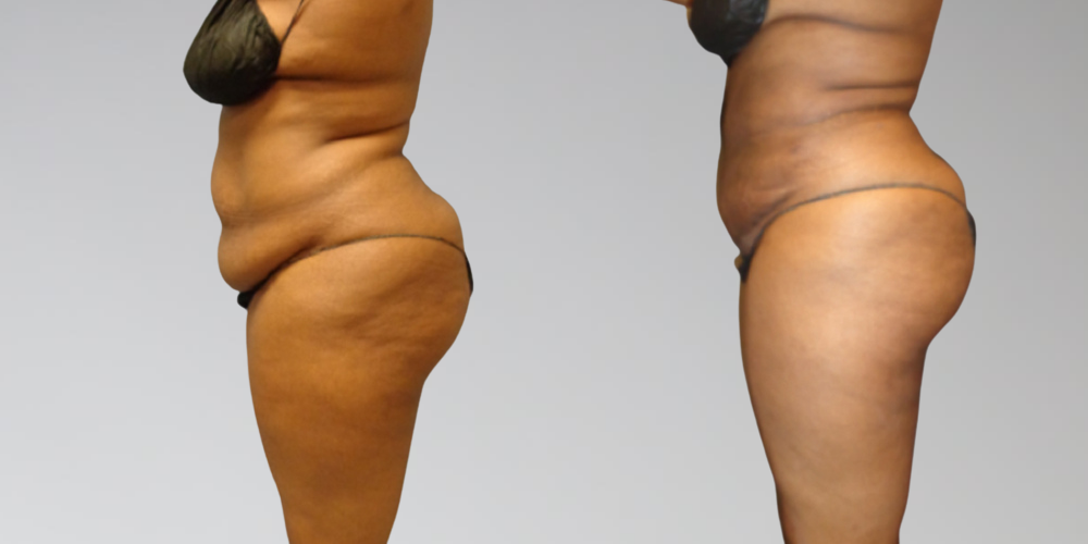 Liposuction and excess skin removal results from Sono Bello AbEX procedure