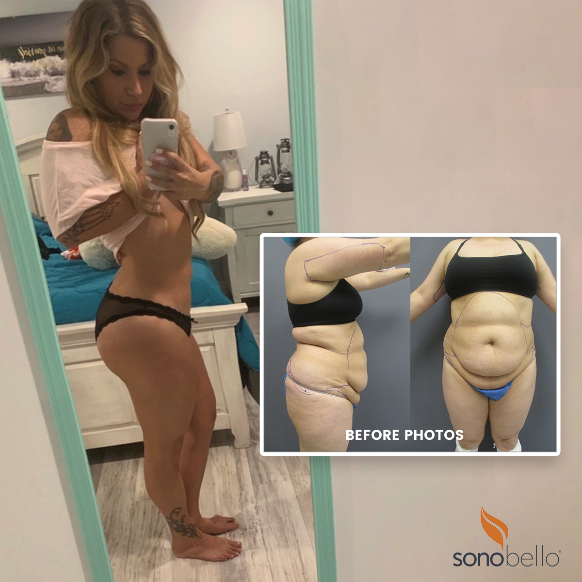 [07/2023] Brooke’s Liposuction Procedure Transformation
