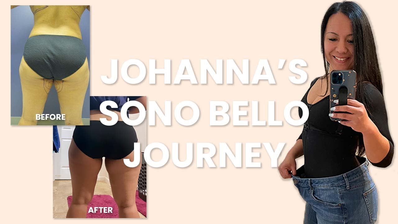 Watch a video about Johanna's Sono Bello journey